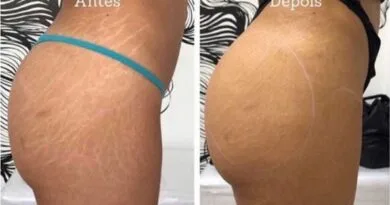 A camuflagem de estrias sem tinta é uma opção para quem deseja disfarçar marcas indesejadas.