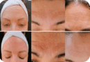 Descubra o que é um curso online de botox sem agulhas, suas vantagens, e como escolher o melhor para aprender esta inovação no mundo da estética.