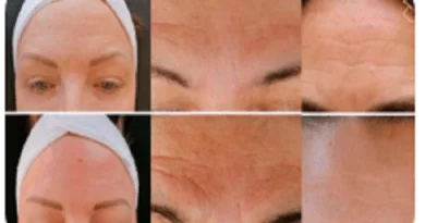 Descubra o que é um curso online de botox sem agulhas, suas vantagens, e como escolher o melhor para aprender esta inovação no mundo da estética.