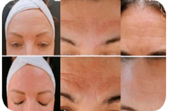 Descubra o que é um curso online de botox sem agulhas, suas vantagens, e como escolher o melhor para aprender esta inovação no mundo da estética.